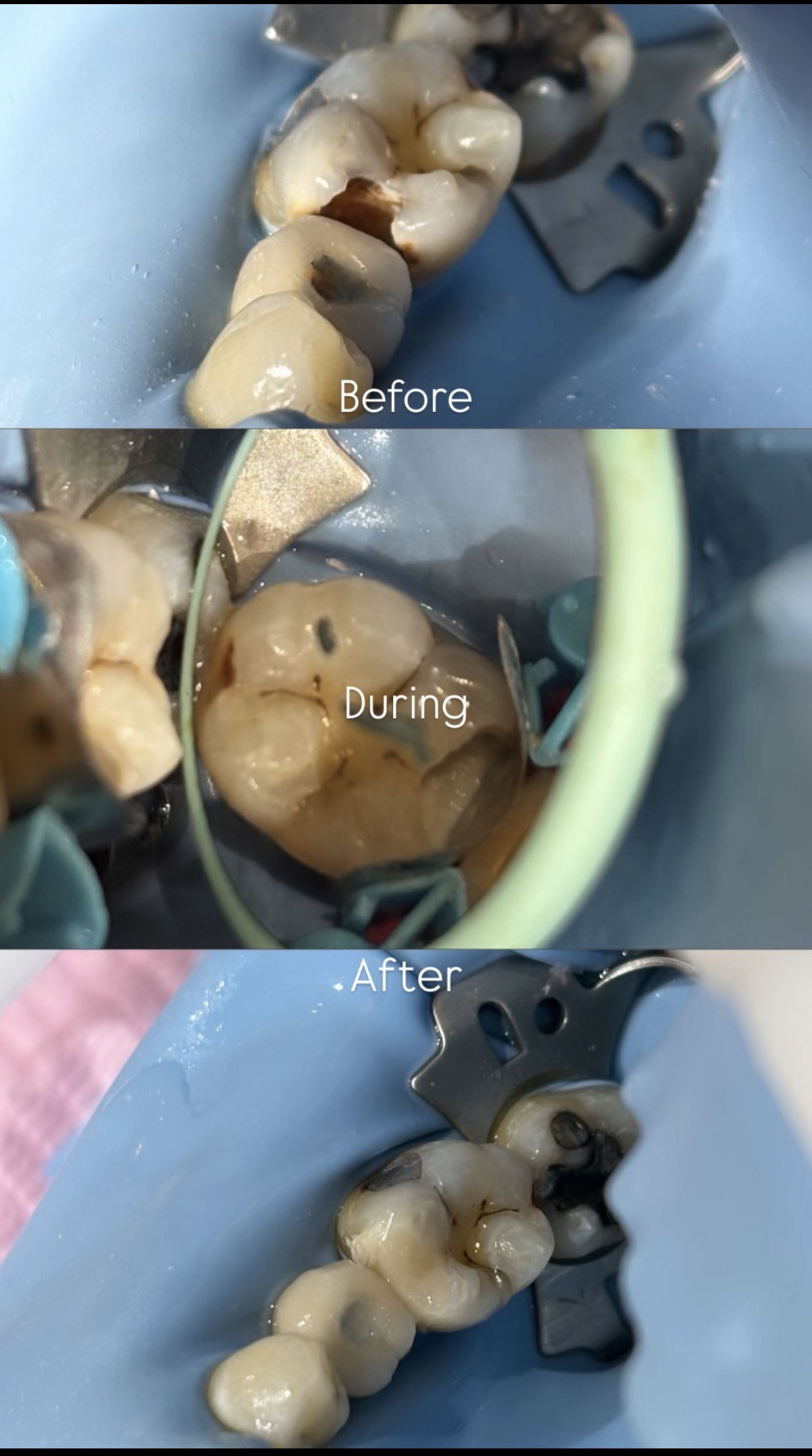 back tooth cavity filling Belapur: before, during and after a tooth-coloured composite filling at La Pearl Dental Boutique
