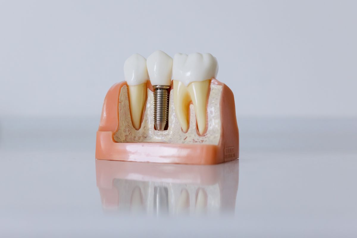 Dental Implant Recovery in CBD Belapur: What to Expect in the First Week