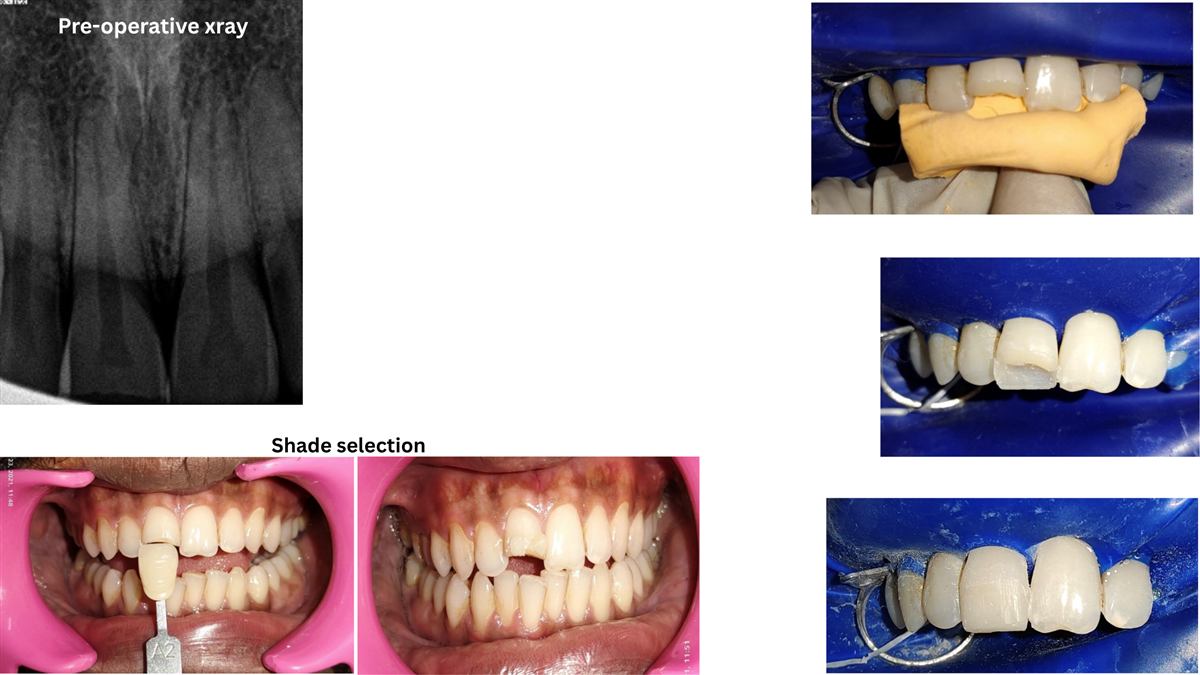 fractured front tooth Belapur: pre-operative X-ray, shade selection and composite build-up at La Pearl Dental Boutique