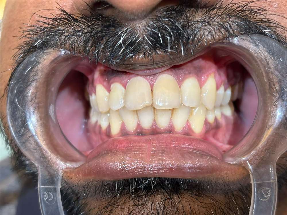 teeth whitening Belapur, before professional whitening at La Pearl Dental Boutique
