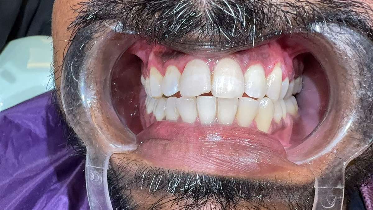 A Real Teeth Whitening Case Study From La Pearl Dental Boutique, CBD Belapur